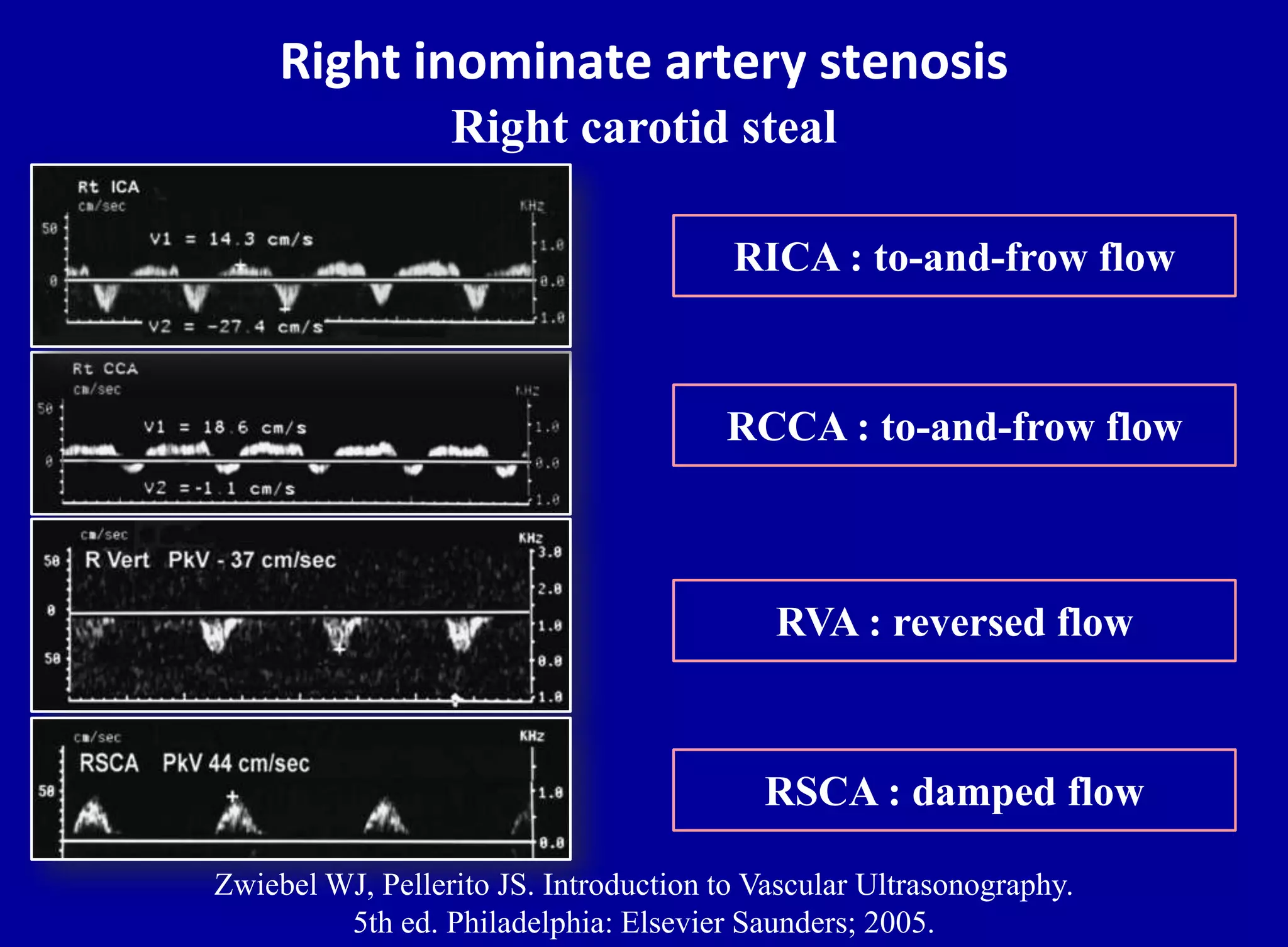 Right inominate artery stenosis
Zwiebel WJ, Pellerito JS. Introduction to Vascular Ultrasonography.
5th ed. Philadelphia: Elsevier Saunders; 2005.
RICA : to-and-frow flow
RCCA : to-and-frow flow
RVA : reversed flow
RSCA : damped flow
Right carotid steal
 
