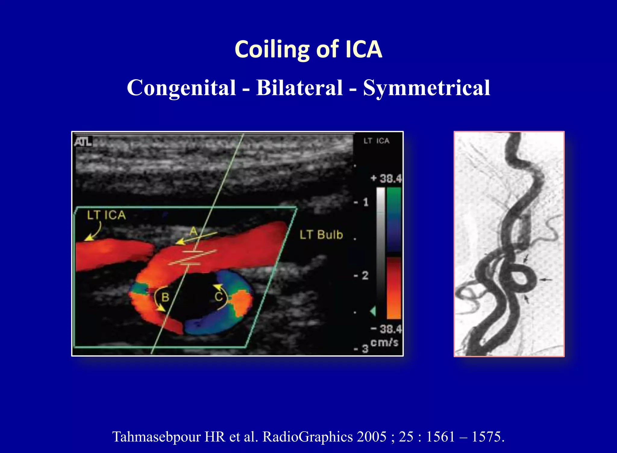 Tahmasebpour HR et al. RadioGraphics 2005 ; 25 : 1561 – 1575.
Coiling of ICA
Congenital - Bilateral - Symmetrical
 