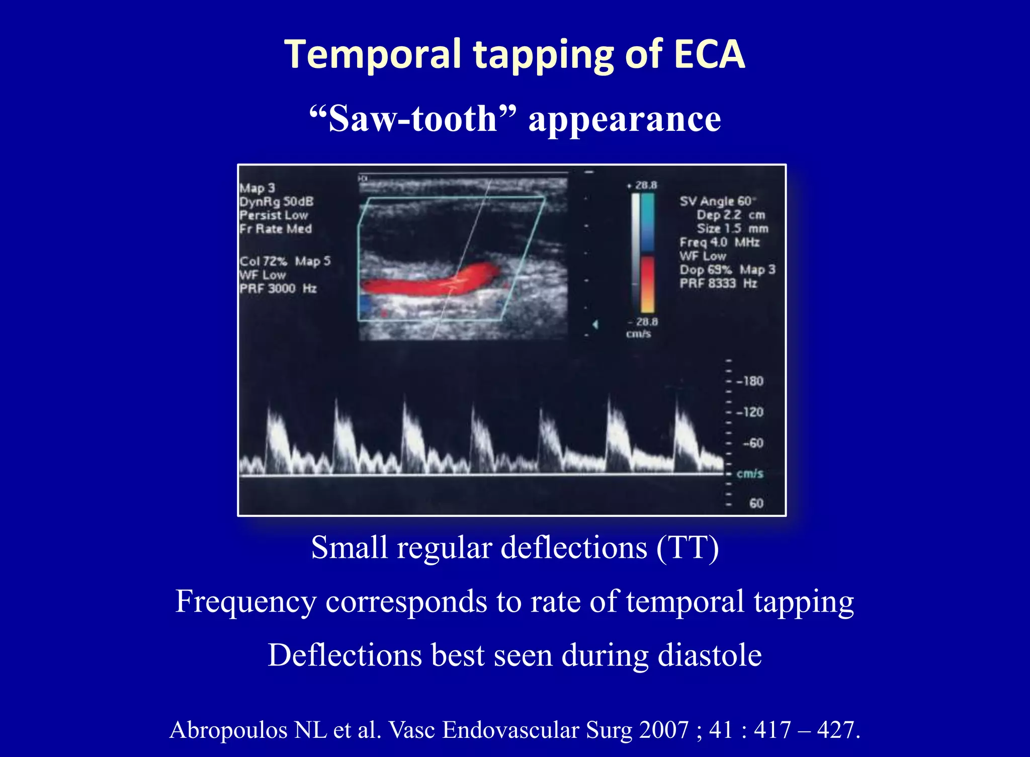 Abropoulos NL et al. Vasc Endovascular Surg 2007 ; 41 : 417 – 427.
Temporal tapping of ECA
“Saw-tooth” appearance
Small regular deflections (TT)
Frequency corresponds to rate of temporal tapping
Deflections best seen during diastole
 