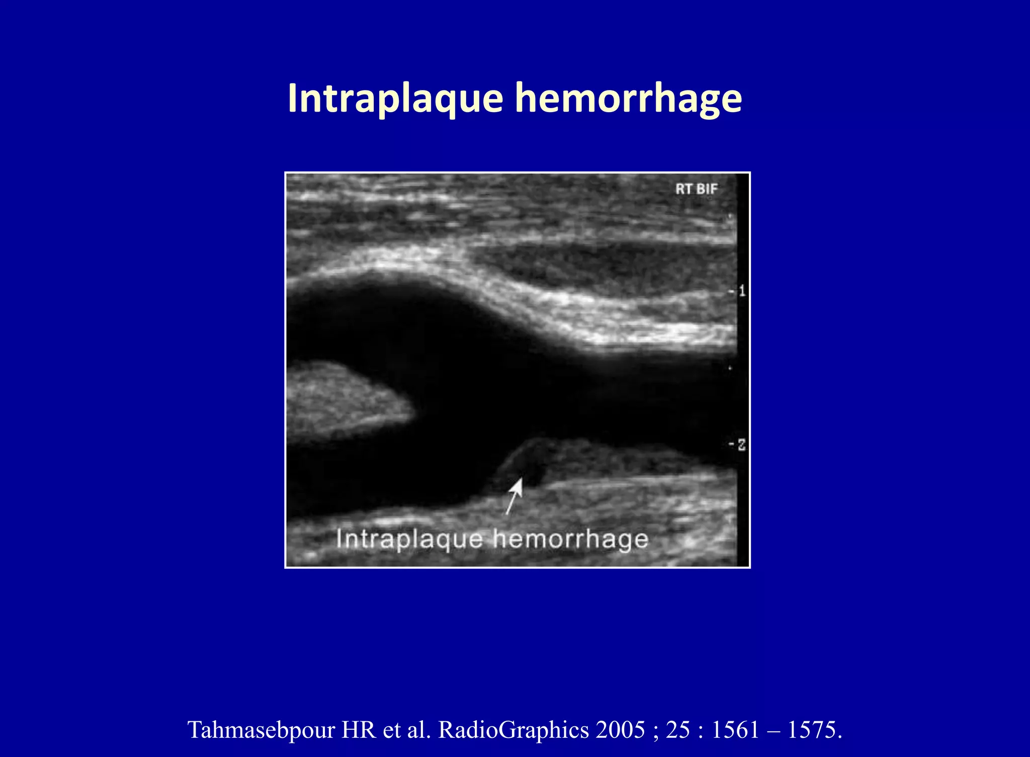 Intraplaque hemorrhage
Tahmasebpour HR et al. RadioGraphics 2005 ; 25 : 1561 – 1575.
 