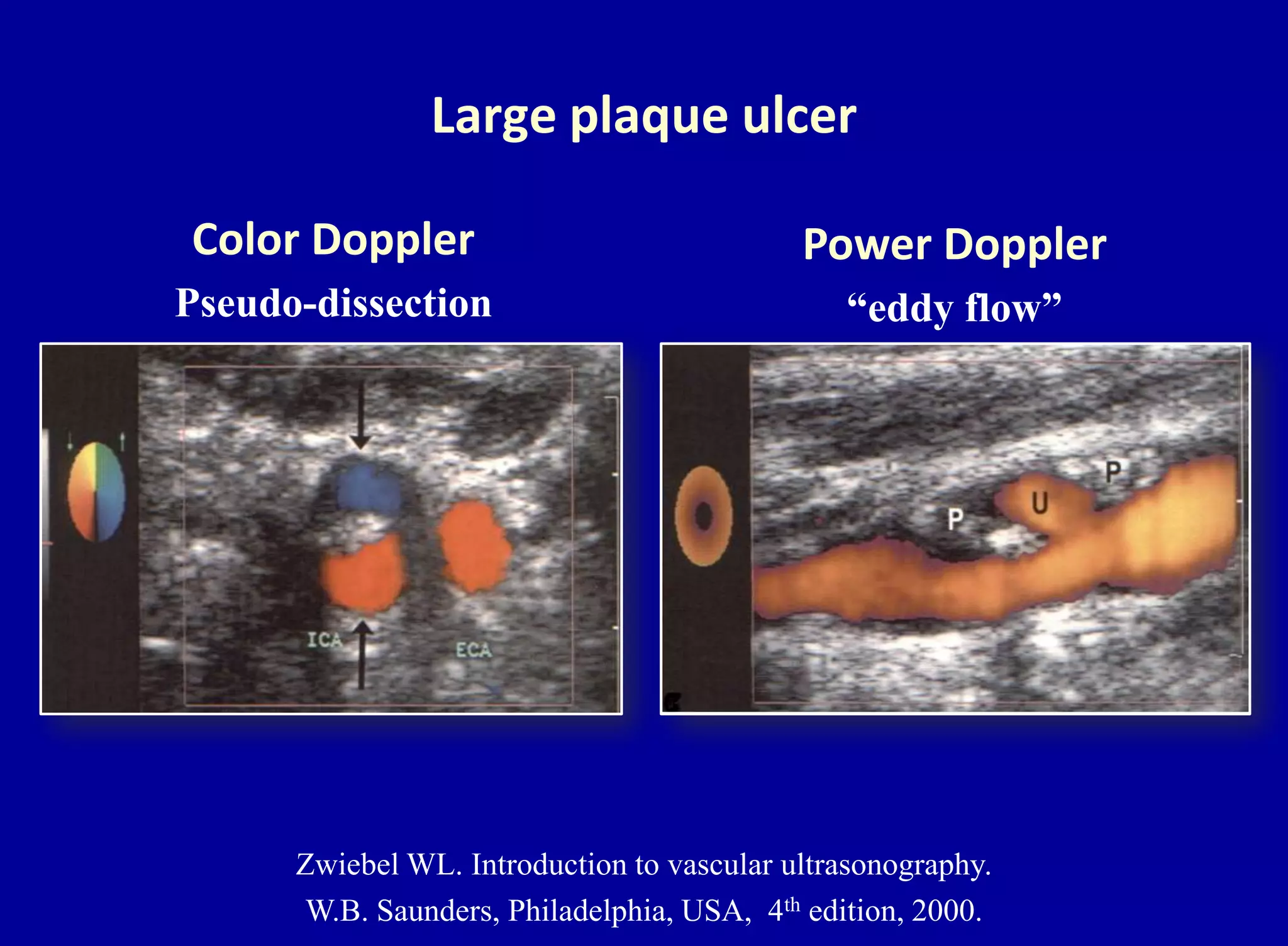Large plaque ulcer
Power Doppler
“eddy flow”
Color Doppler
Pseudo-dissection
Zwiebel WL. Introduction to vascular ultrasonography.
W.B. Saunders, Philadelphia, USA, 4th edition, 2000.
 