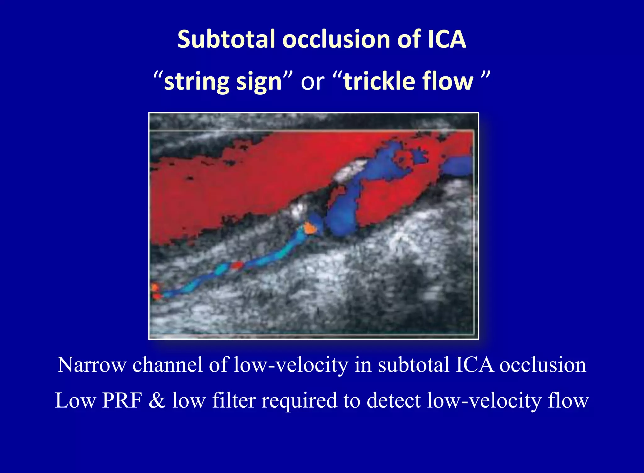 Subtotal occlusion of ICA
“string sign” or “trickle flow ”
Narrow channel of low-velocity in subtotal ICA occlusion
Low PRF & low filter required to detect low-velocity flow
 