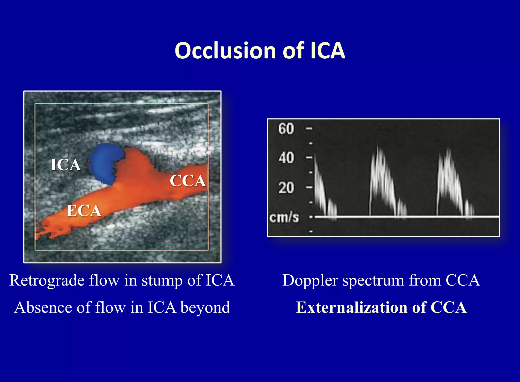 Occlusion of ICA
ICA
ECA
CCA
Retrograde flow in stump of ICA
Absence of flow in ICA beyond
Doppler spectrum from CCA
Externalization of CCA
 