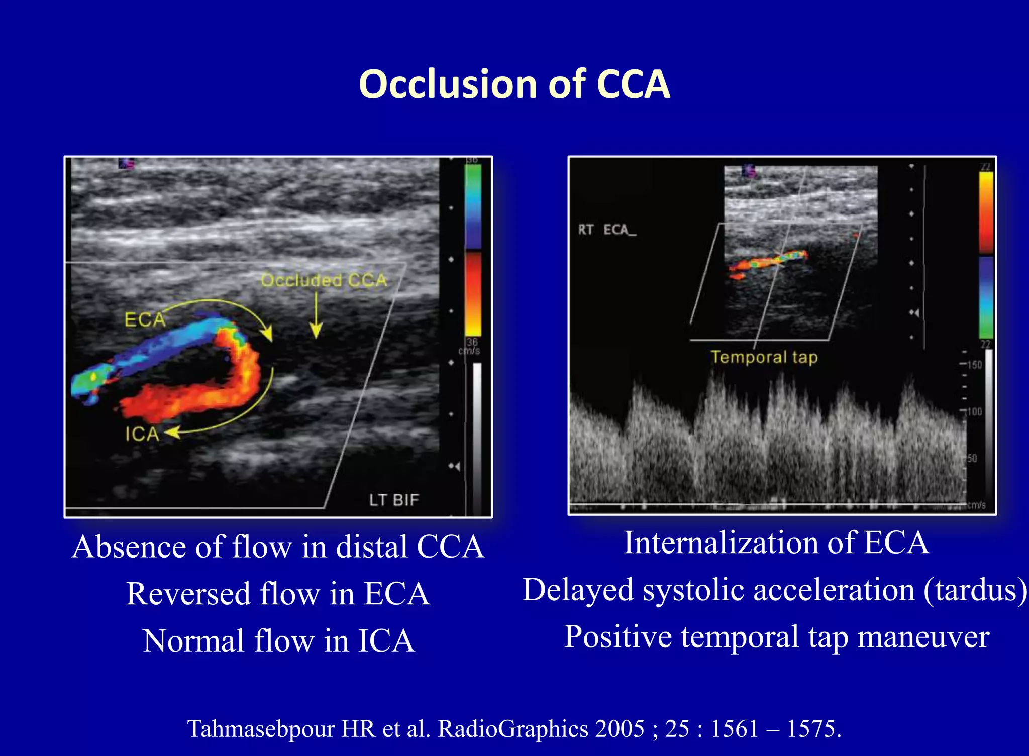 Occlusion of CCA
Tahmasebpour HR et al. RadioGraphics 2005 ; 25 : 1561 – 1575.
Absence of flow in distal CCA
Reversed flow in ECA
Normal flow in ICA
Internalization of ECA
Delayed systolic acceleration (tardus)
Positive temporal tap maneuver
 