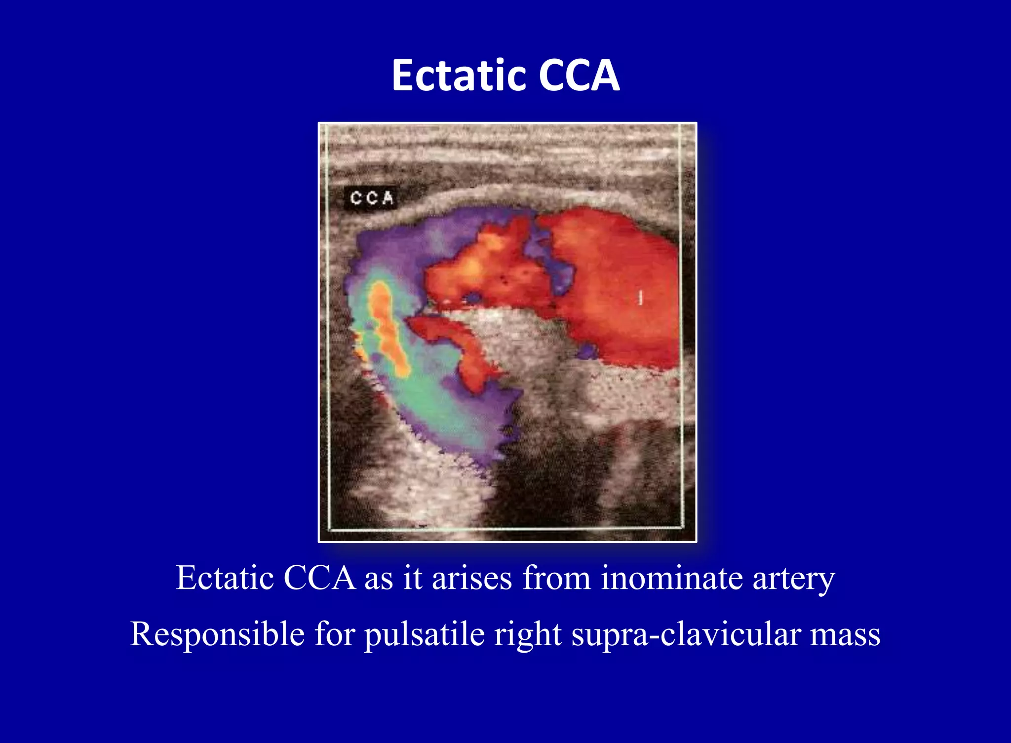 Ectatic CCA
Ectatic CCA as it arises from inominate artery
Responsible for pulsatile right supra-clavicular mass
 