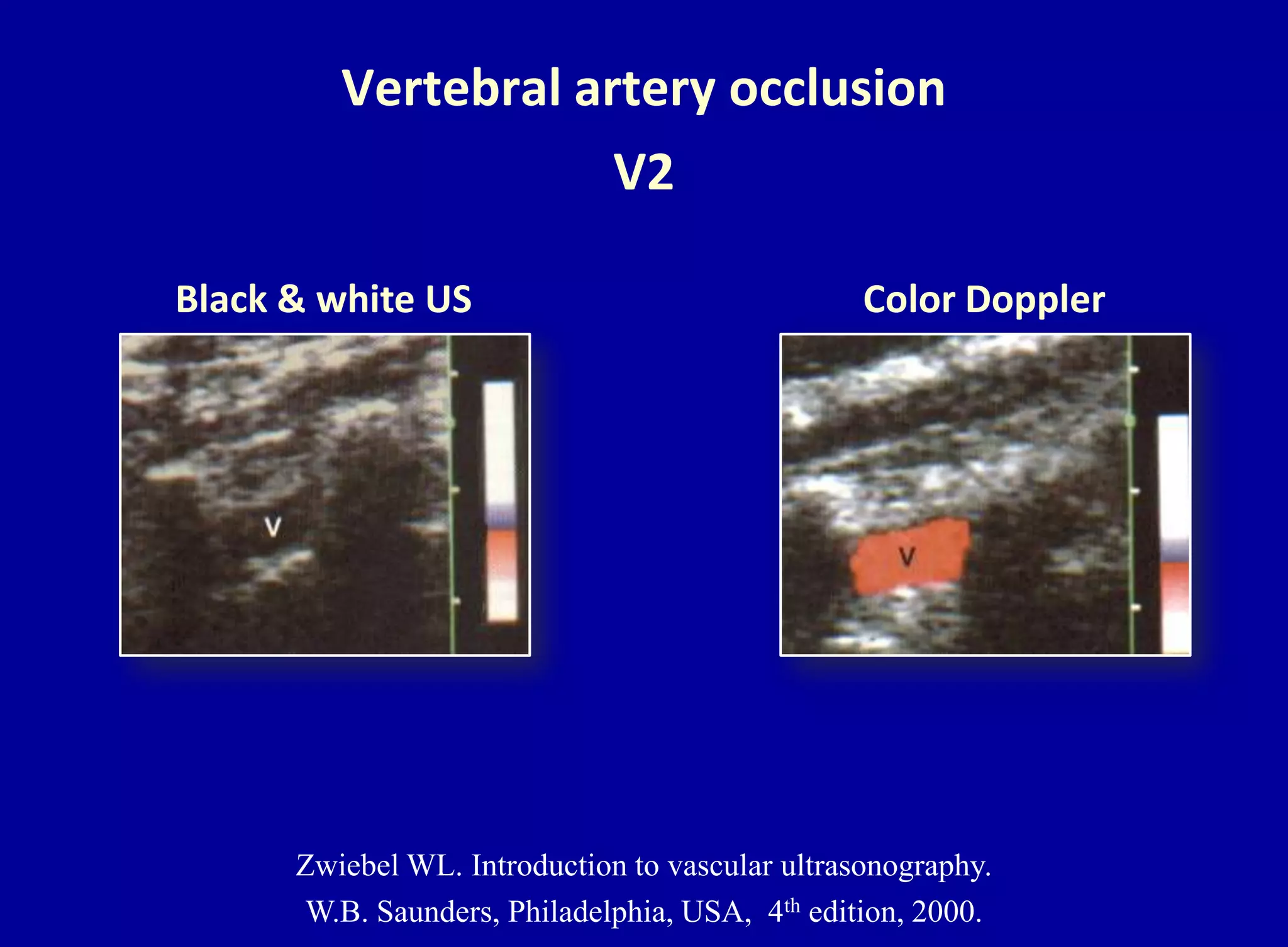 Vertebral artery occlusion
V2
Black & white US Color Doppler
Zwiebel WL. Introduction to vascular ultrasonography.
W.B. Saunders, Philadelphia, USA, 4th edition, 2000.
 