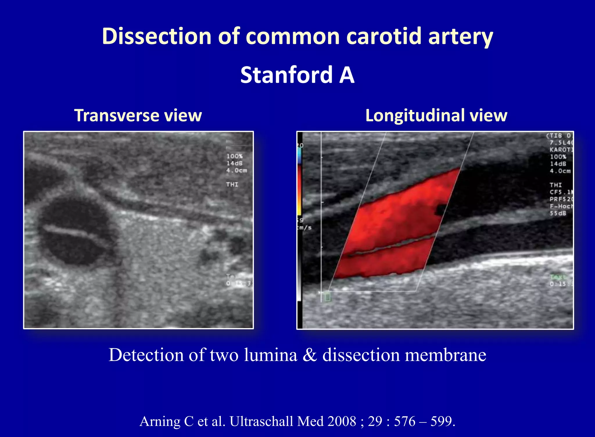 Dissection of common carotid artery
Stanford A
Arning C et al. Ultraschall Med 2008 ; 29 : 576 – 599.
Transverse view Longitudinal view
Detection of two lumina & dissection membrane
 