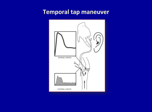 Doppler ultrasound of carotid arteries | PPTX