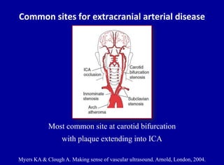 Doppler ultrasound of carotid arteries | PPTX
