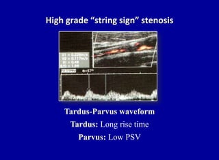 String. Sign Waveform Doppler ultrasound of carotid arteries | PPTX