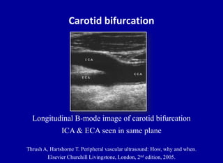 Doppler ultrasound of carotid arteries