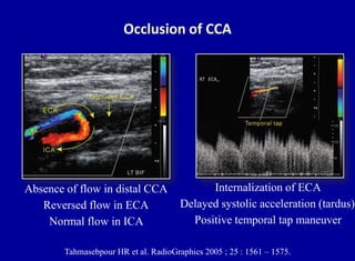 Doppler ultrasound of carotid arteries
