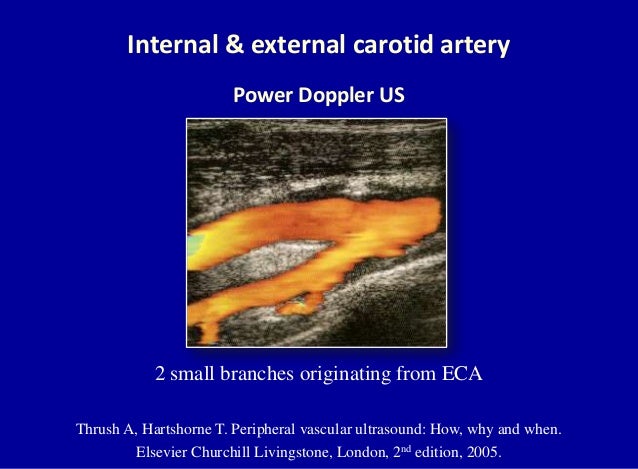 Doppler ultrasound of carotid arteries