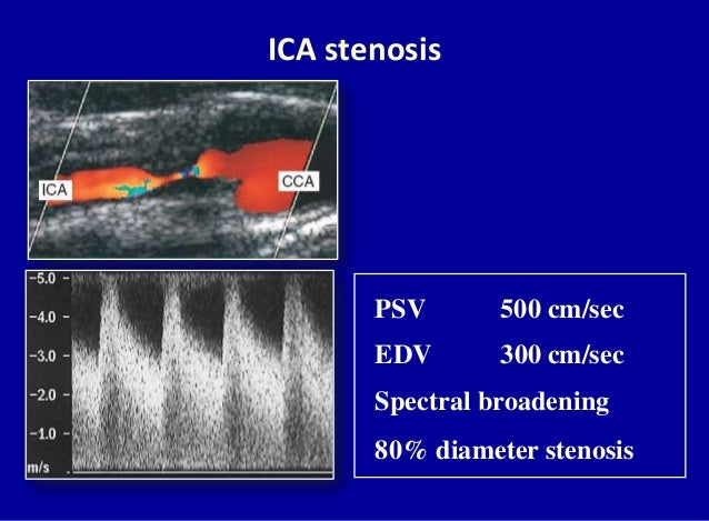 Doppler Ultrasound Of Carotid Arteries