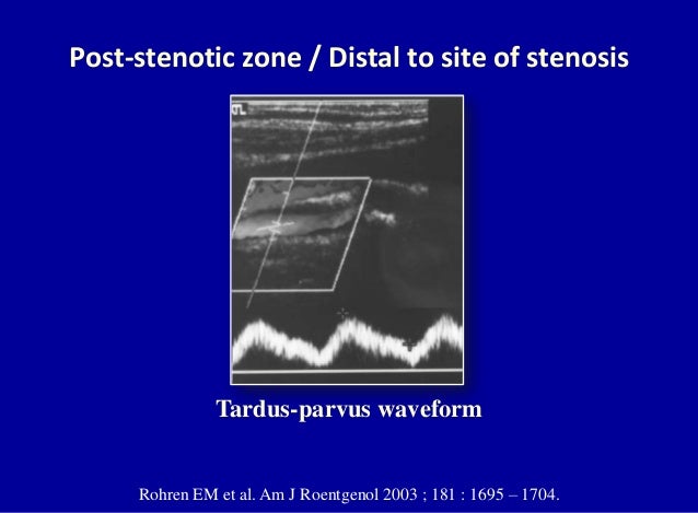 Doppler ultrasound of carotid arteries