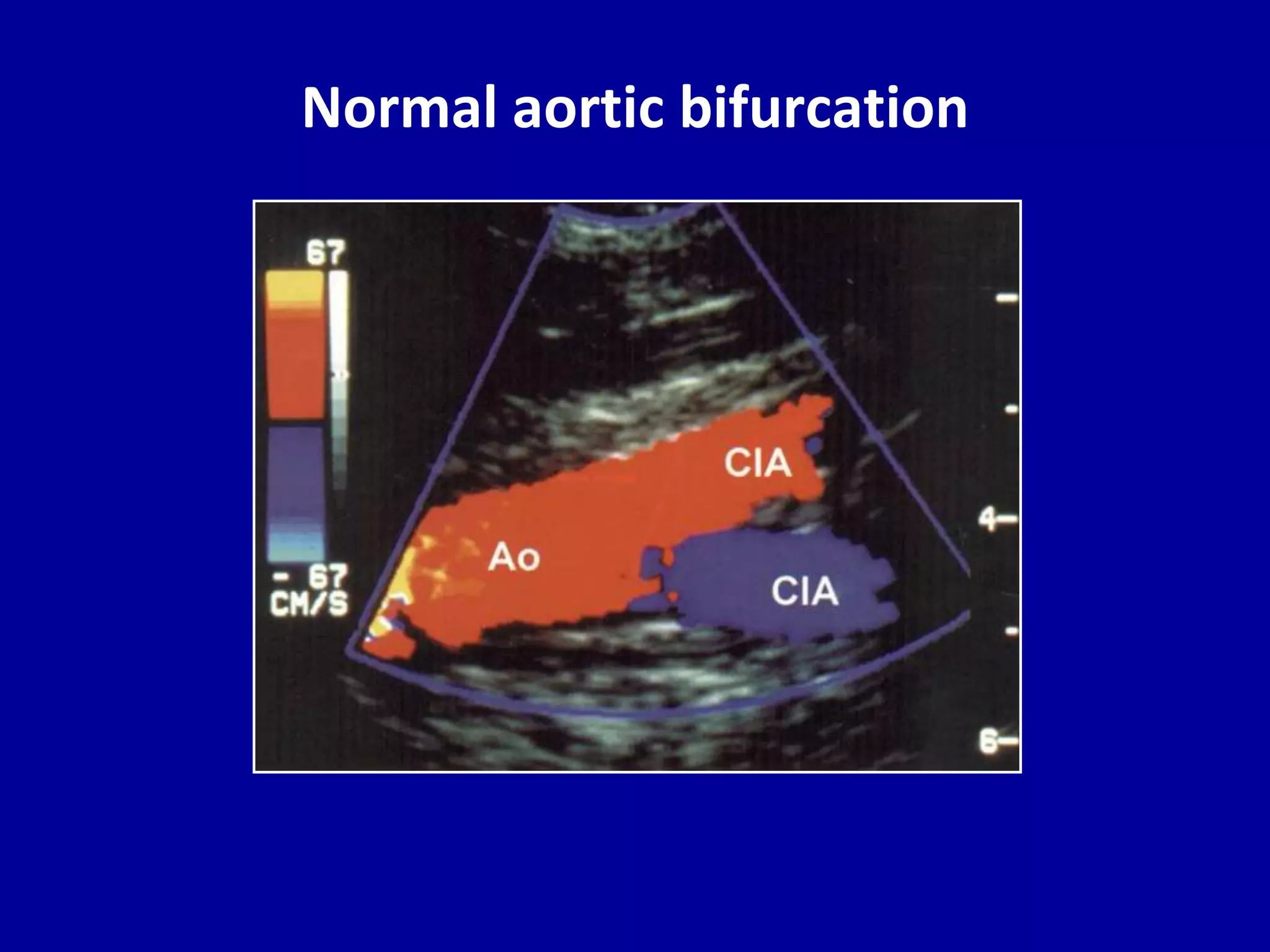 Doppler ultrasound of lower limb arteries | PPTX