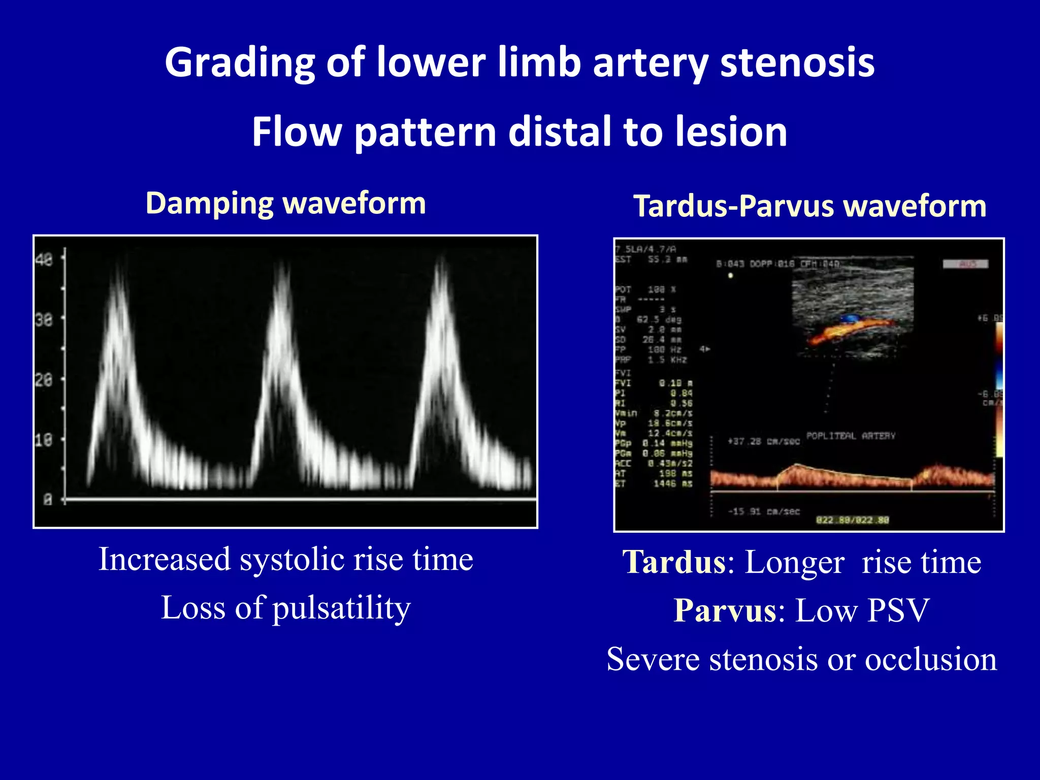 Doppler ultrasound of lower limb arteries | PPTX