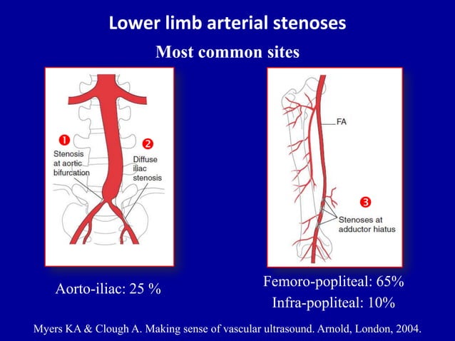Doppler ultrasound of lower limb arteries | PPTX | Death, Injury, or ...