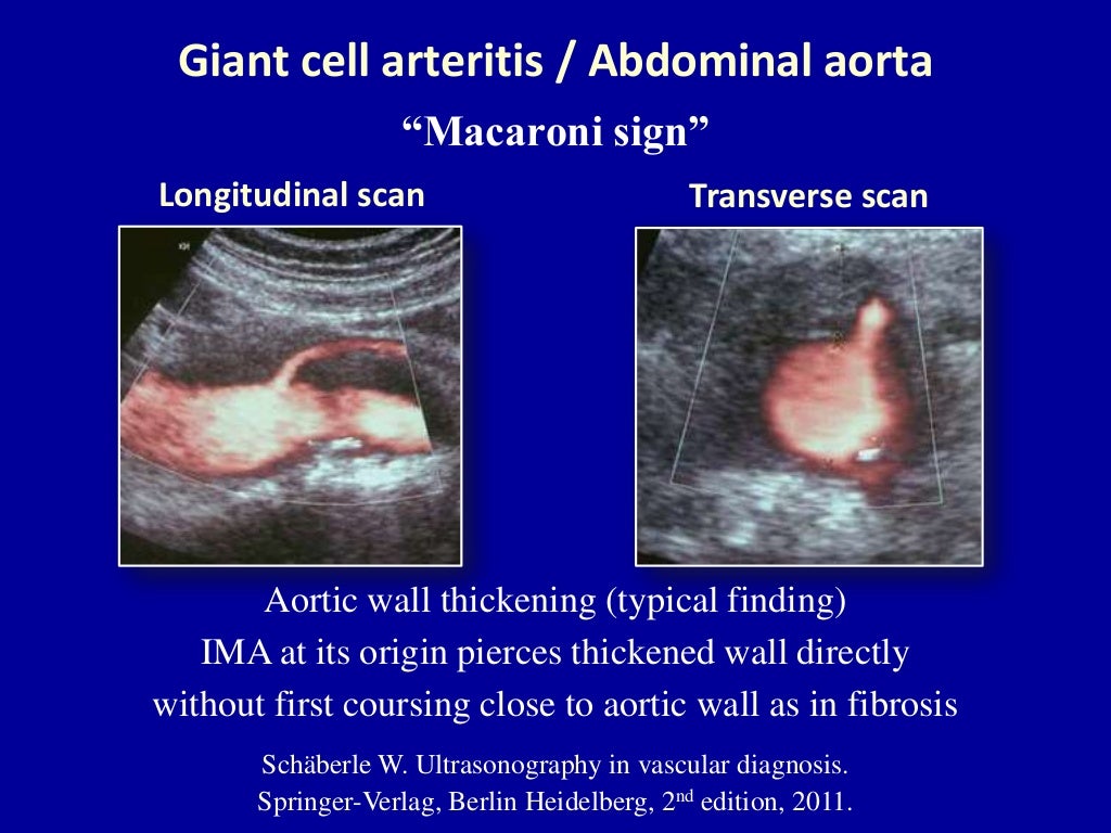 lower extremity doppler