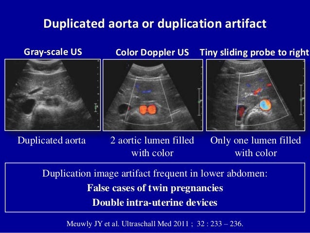 ultrasound doppler limb arteries aorta duplication duplicated ultraschall aplasia