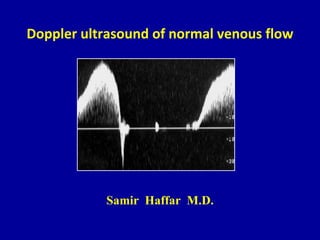 Doppler ultrasound of normal venous flow
Samir Haffar M.D.
 