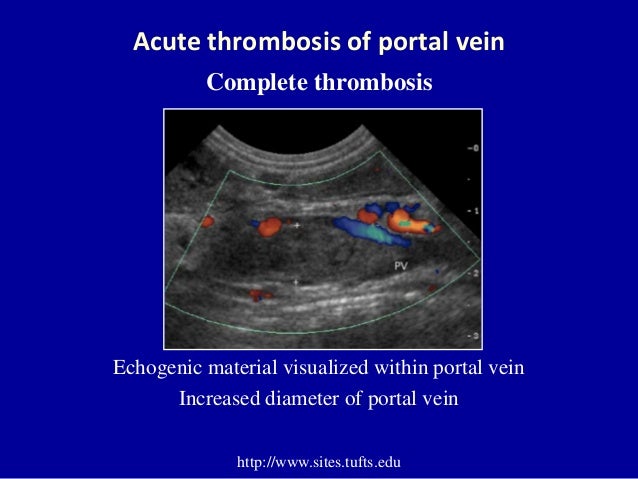 Doppler ultrasound of portal vein thrombosis