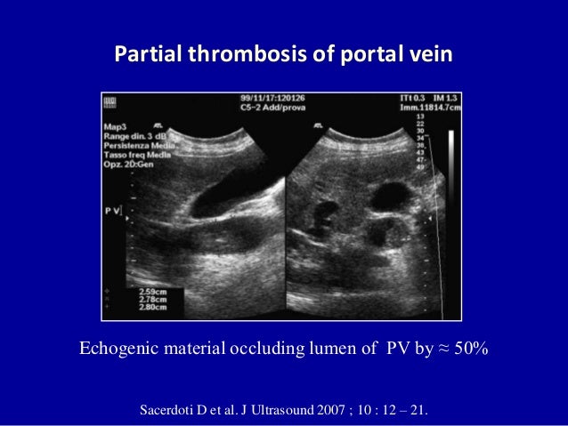 Doppler ultrasound of portal vein thrombosis
