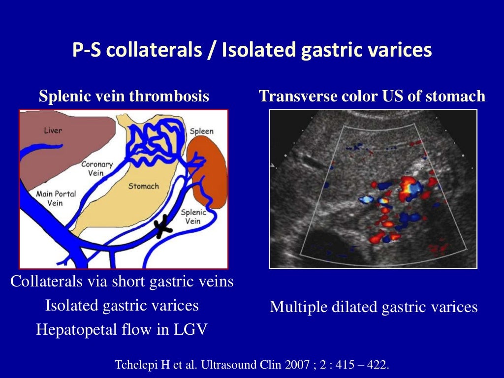 Doppler ultrasound of portal vein thrombosis