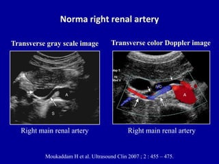 Renal Ultrasound Transverse