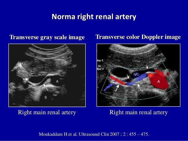 doppler ultrasound of the kidneys