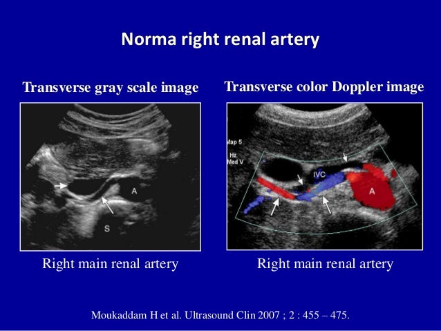 What is renal artery ultrasound?