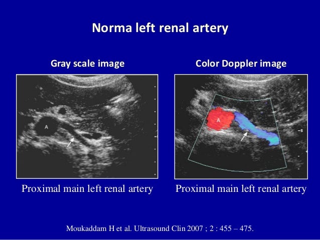 Doppler ultrasound of the kidneys renal cyst diagram 