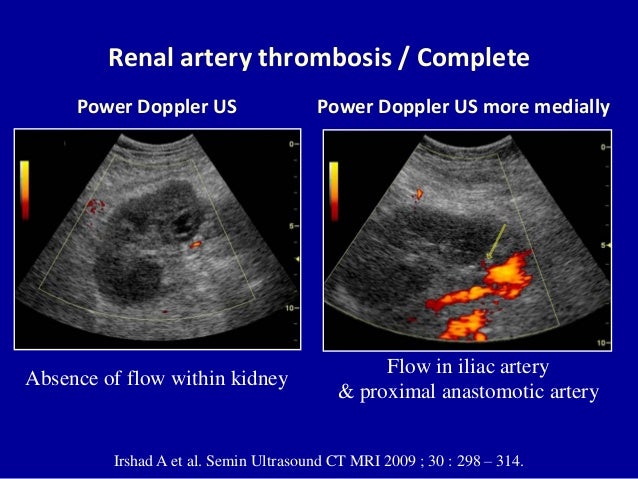 doppler ultrasound of the kidneys