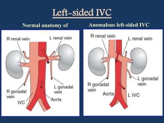 Ivc Normal Variants Doppler ultrasound of the Kidney | PPTX