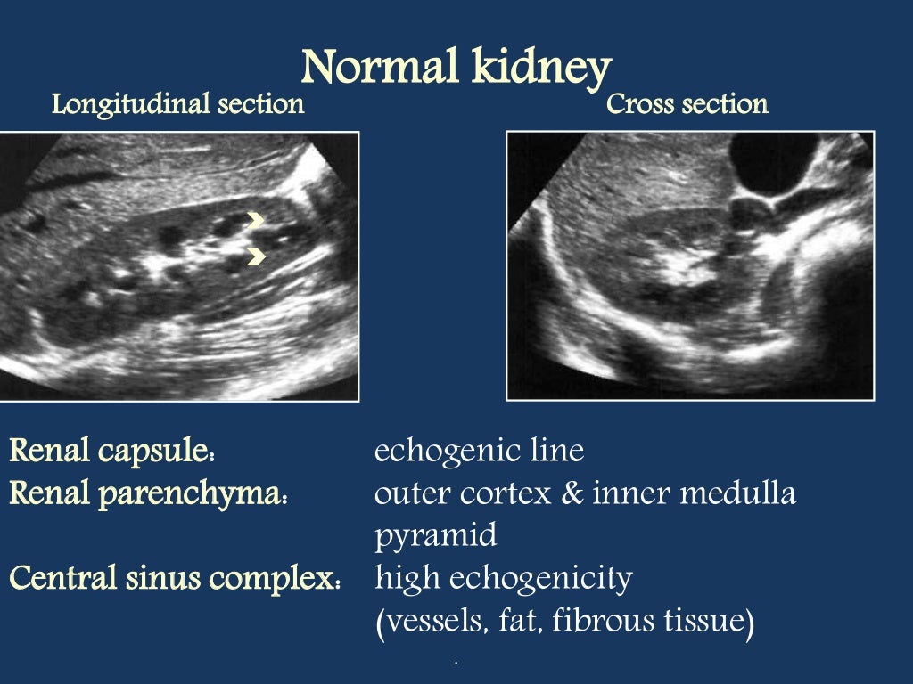 Doppler ultrasound of the Kidney