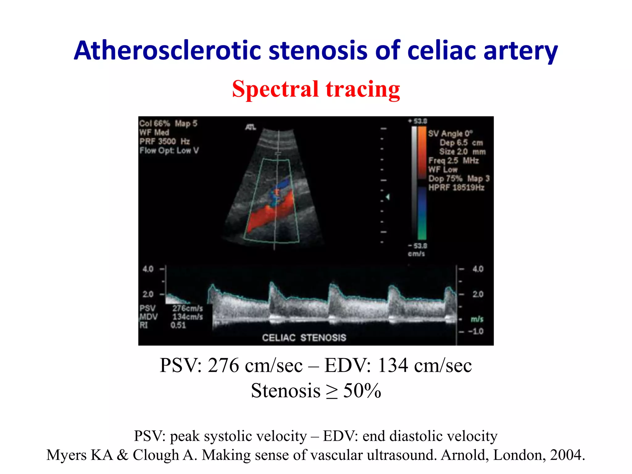 Doppler ultrasound of visceral arteries | PPTX