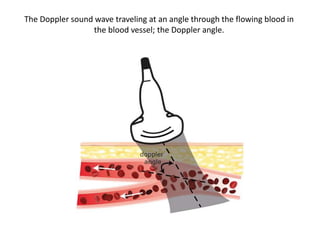 The Doppler sound wave traveling at an angle through the flowing blood in
the blood vessel; the Doppler angle.
 