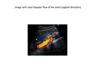 . Image with color Doppler flow of the aorta (sagittal direction).
 