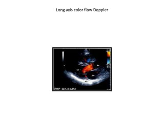 Long axis color flow Doppler
 