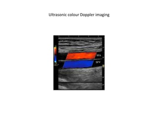 Ultrasonic colour Doppler imaging
 