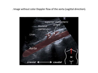 . Image without color Doppler flow of the aorta (sagittal direction).
 