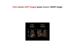 Color doppler (LEFT image)/ power doppler (RIGHT image)
 