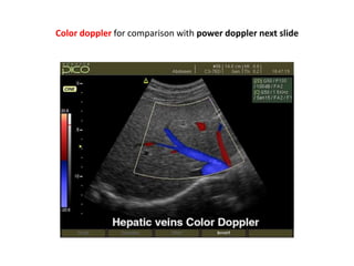 Color doppler for comparison with power doppler next slide
 