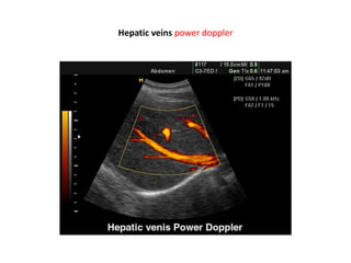 Hepatic veins power doppler
 