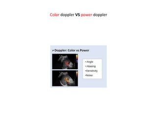 Color doppler VS power doppler
 