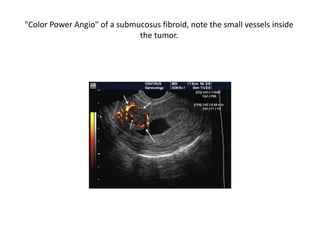 "Color Power Angio" of a submucosus fibroid, note the small vessels inside
the tumor.
 