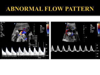 Doppler us in the evaluation of fetal growth | PPTX