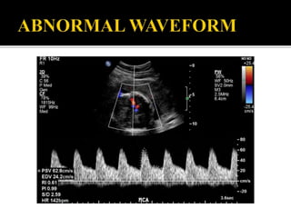 Doppler us in the evaluation of fetal growth | PPTX