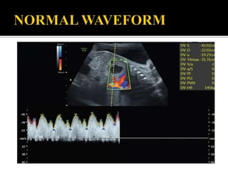 Doppler us in the evaluation of fetal growth | PPTX