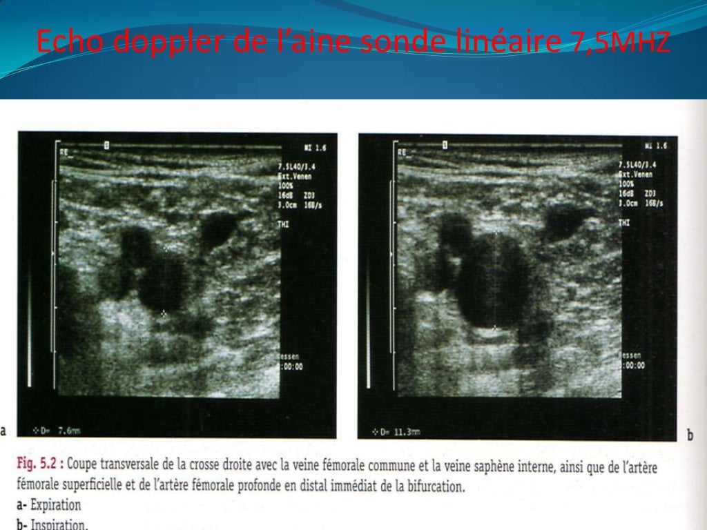 Rdv Echo Doppler Veineux Des Membres Inférieurs Doppler veineux